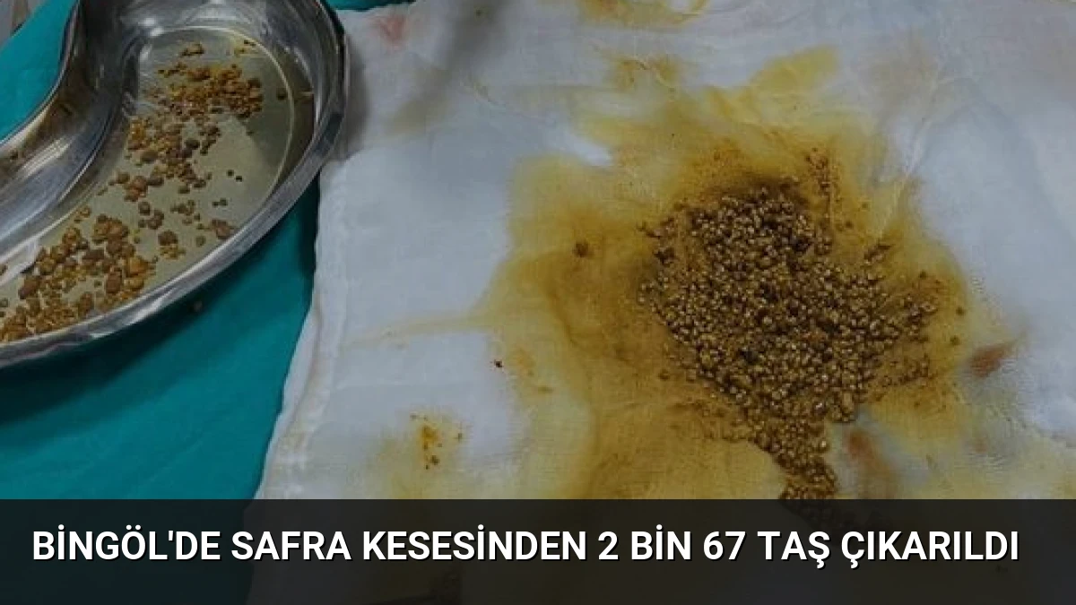 Bingöl’de Safra Kesesinden 2 Bin 67 Taş Çıkarıldı
