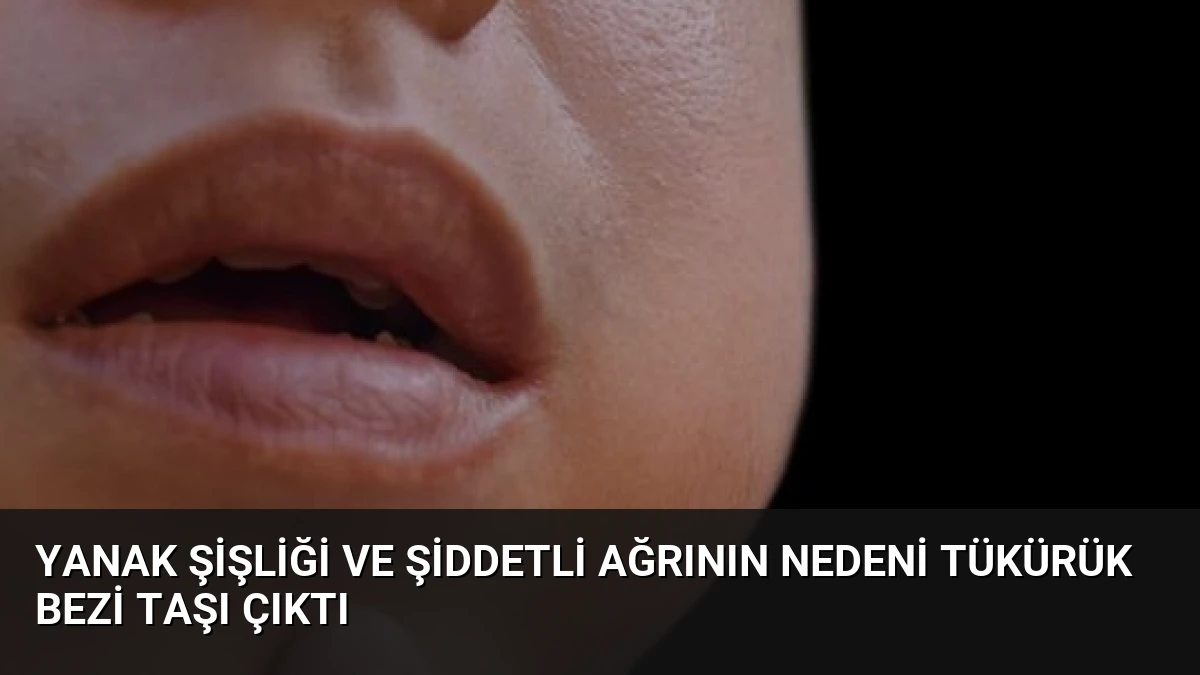 Yanak Şişliği ve Şiddetli Ağrının Nedeni Tükürük Bezi Taşı Çıktı