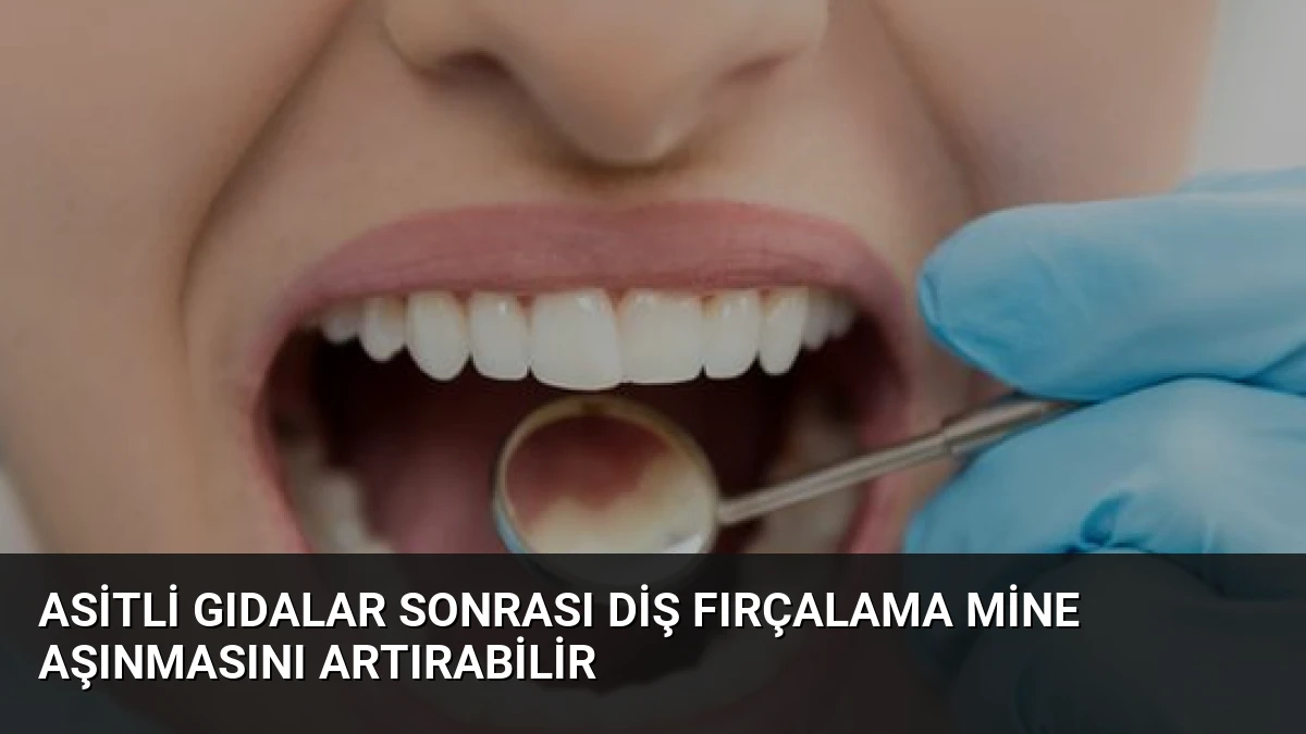 Asitli Gıdalar Sonrası Diş Fırçalama Mine Aşınmasını Artırabilir